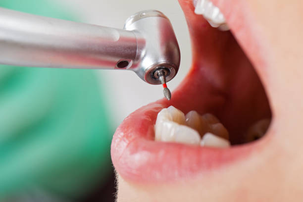 Best Lost Filling or Crown Replacement in Nevada, MO